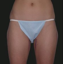 Liposuction before and after, case 04 (before)