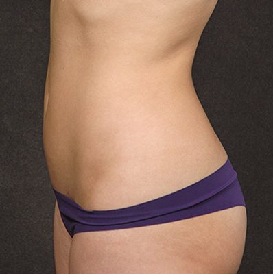 Liposuction before and after, case 05, view 6 (after)