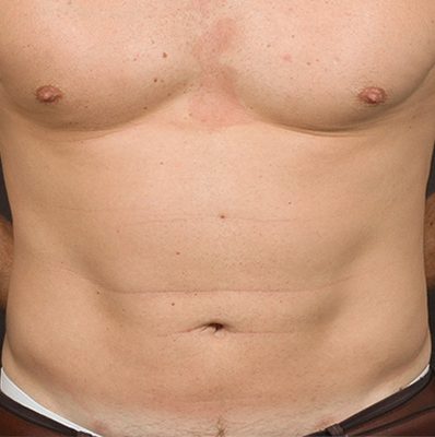 Liposuction after, case 06