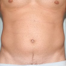 Liposuction before and after, case 06 (before)