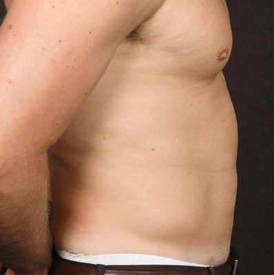 Liposuction before and after, case 06, view 3 (after)