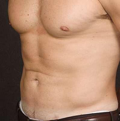 Liposuction before and after, case 06, view 4 (after)