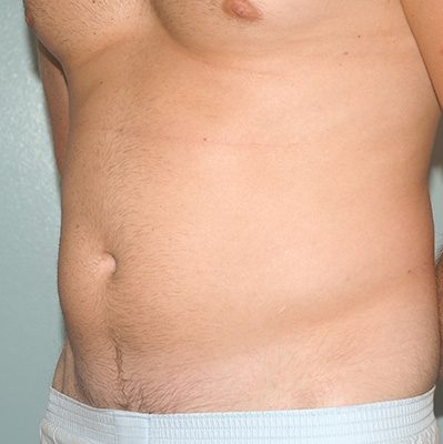 Liposuction before and after, case 06, view 4 (before)