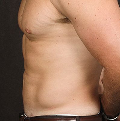 Liposuction before and after, case 06, view 5 (after)