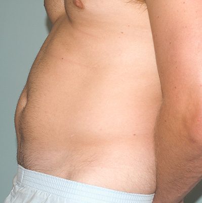 Liposuction before and after, case 06, view 5 (before)