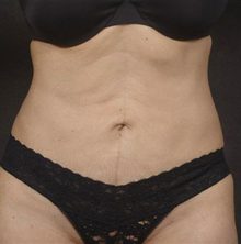 Liposuction before and after, case 07 (after)