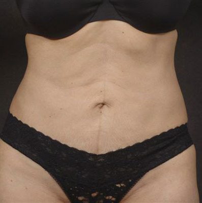 Liposuction after, case 07