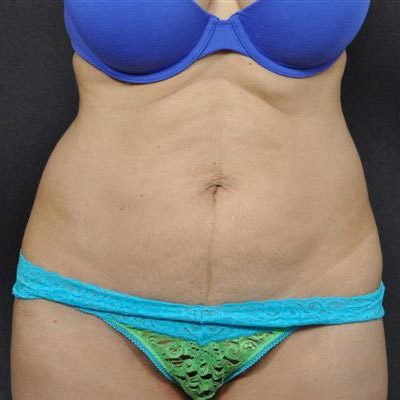 Liposuction before, case 07