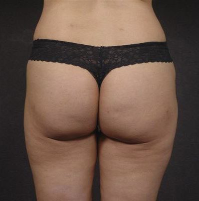 Liposuction before and after, case 07, view 3 (after)