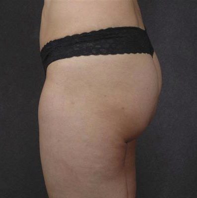 Liposuction before and after, case 07, view 4 (after)