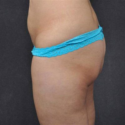 Liposuction before and after, case 07, view 4 (before)
