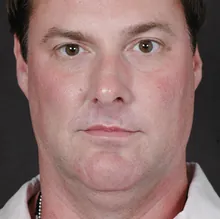 Male Ponytail Facelift™, case 01, before