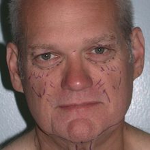 Male Ponytail Facelift before and after, case 02 (before)
