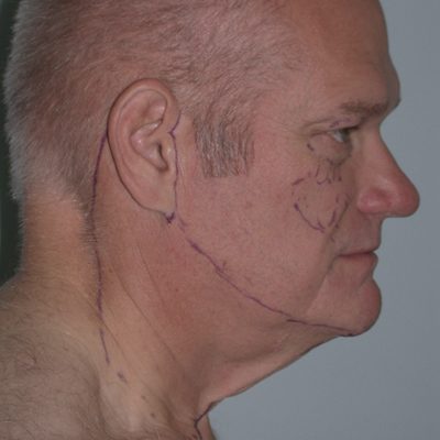 Male Ponytail Facelift before and after, case 02, view 3 (before)