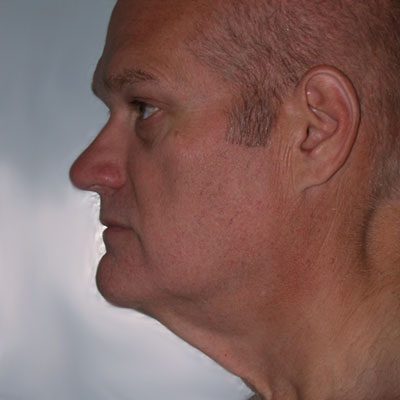 Male Ponytail Facelift before and after, case 02, view 4 (before)