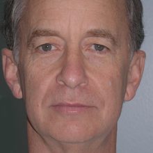 Male Ponytail Facelift before and after, case 03 (before)
