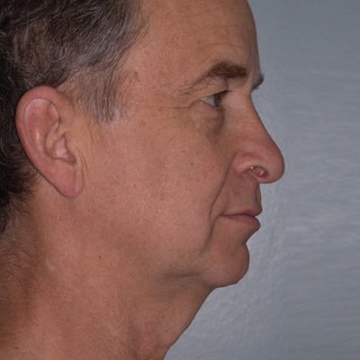 Male Ponytail Facelift before and after, case 03, view 3 (before)