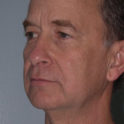 Male Ponytail Facelift before and after, case 03, view 4 (before)