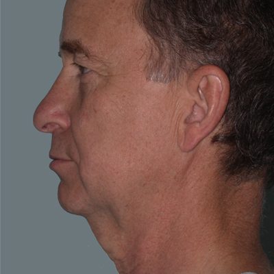 Male Ponytail Facelift before and after, case 03, view 5 (before)