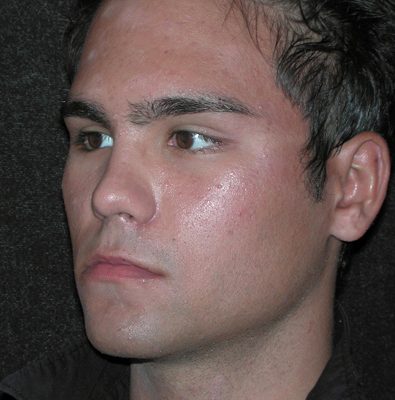 Male Ponytail Lift after, case 01