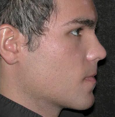 Male Ponytail Lift before and after, case 01, view 3 (after)