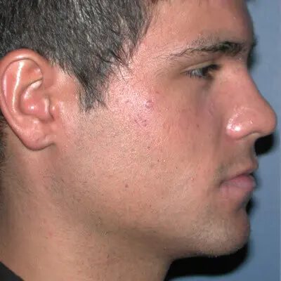 Male Ponytail Lift before and after, case 01, view 3 (before)