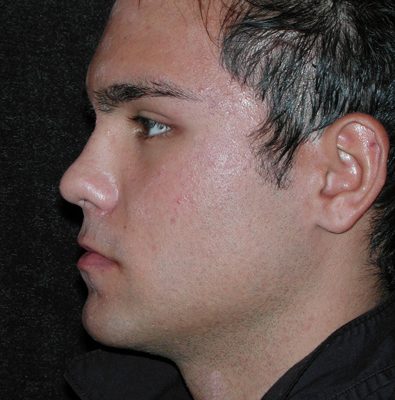 Male Ponytail Lift before and after, case 01, view 4 (after)
