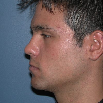 Male Ponytail Lift before and after, case 01, view 4 (before)