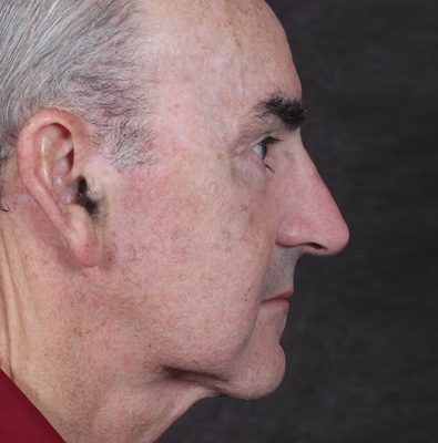 Male Ponytail Lift before and after, case 02, view 4 (after)