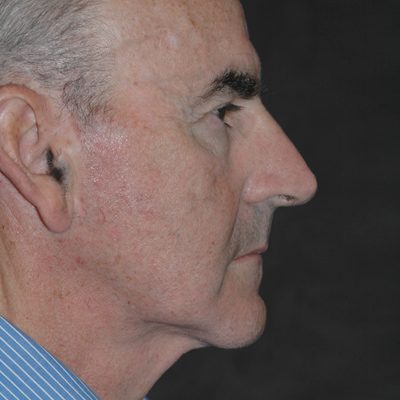 Male Ponytail Lift before and after, case 02, view 4 (before)