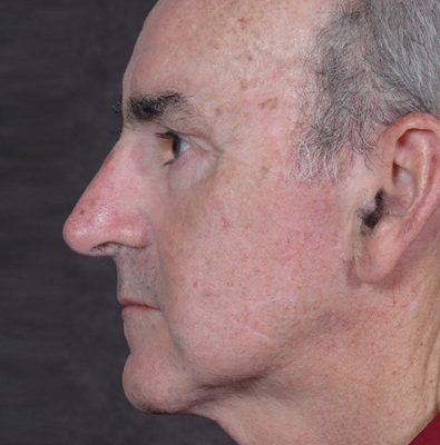 Male Ponytail Lift before and after, case 02, view 5 (after)