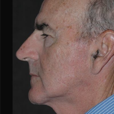 Male Ponytail Lift before and after, case 02, view 5 (before)