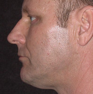 Male Ponytail Lift before and after, case 03, view 3 (after)