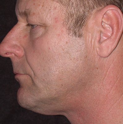 Male Ponytail Lift before and after, case 03, view 3 (before)