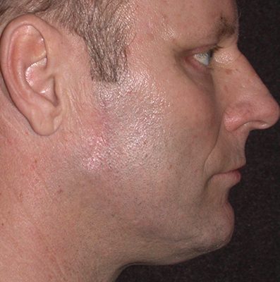 Male Ponytail Lift before and after, case 03, view 5 (after)