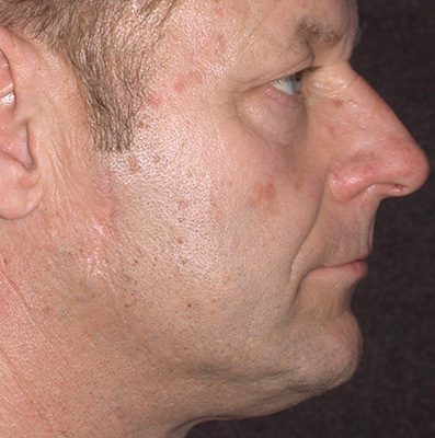 Male Ponytail Lift before and after, case 03, view 5 (before)