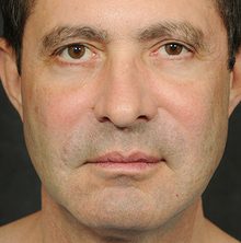 Male Ponytail Lift before and after, case 04 (before)