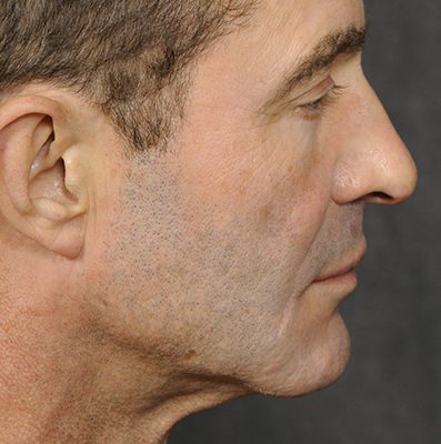 Male Ponytail Lift before and after, case 04, view 4 (after)