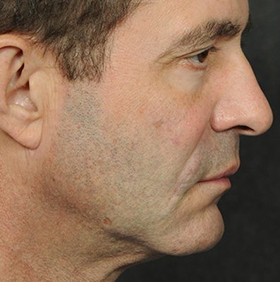 Male Ponytail Lift before and after, case 04, view 4 (before)