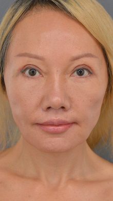 Ponytail Facelift before and after, case 01 (after)