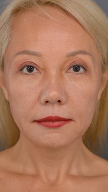 Ponytail Facelift before and after, case 01 (before)