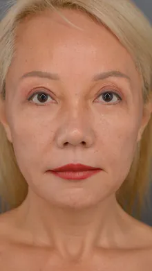 Ponytail Facelift™, case 01, before
