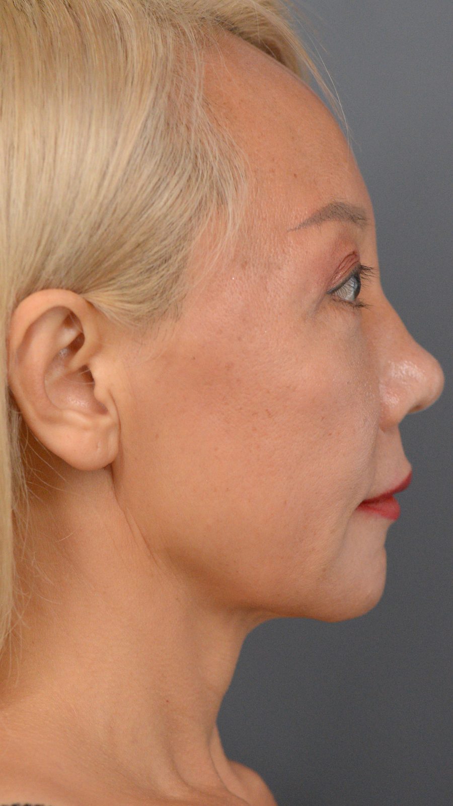 Ponytail Facelift before and after, case 01, view 3 (before)