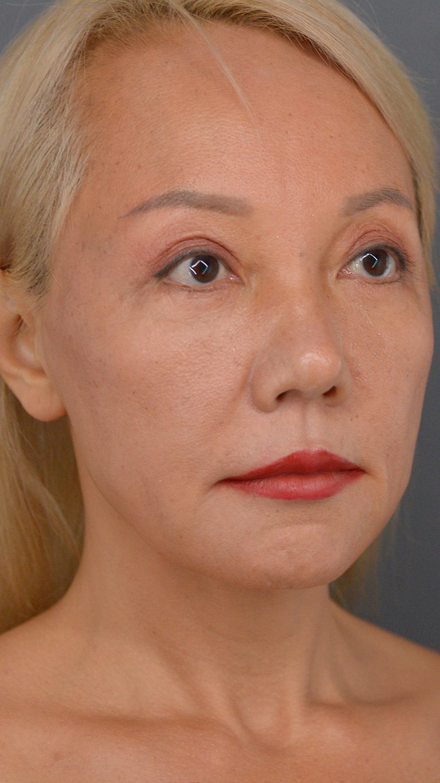 Ponytail Facelift before and after, case 01, view 4 (before)