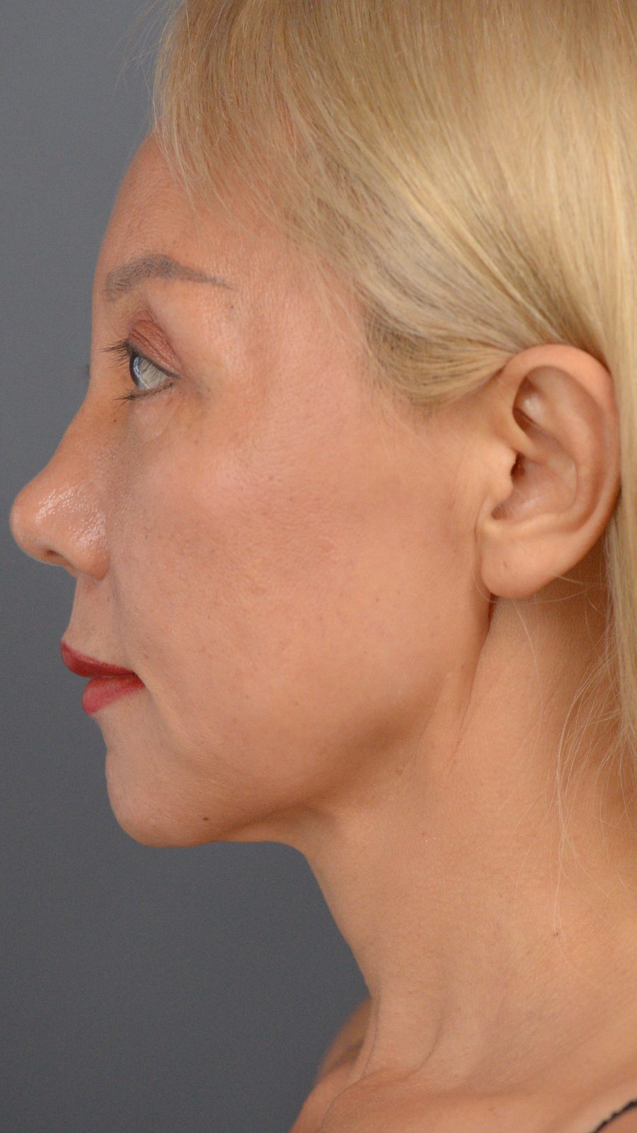 Ponytail Facelift before and after, case 01, view 6 (before)