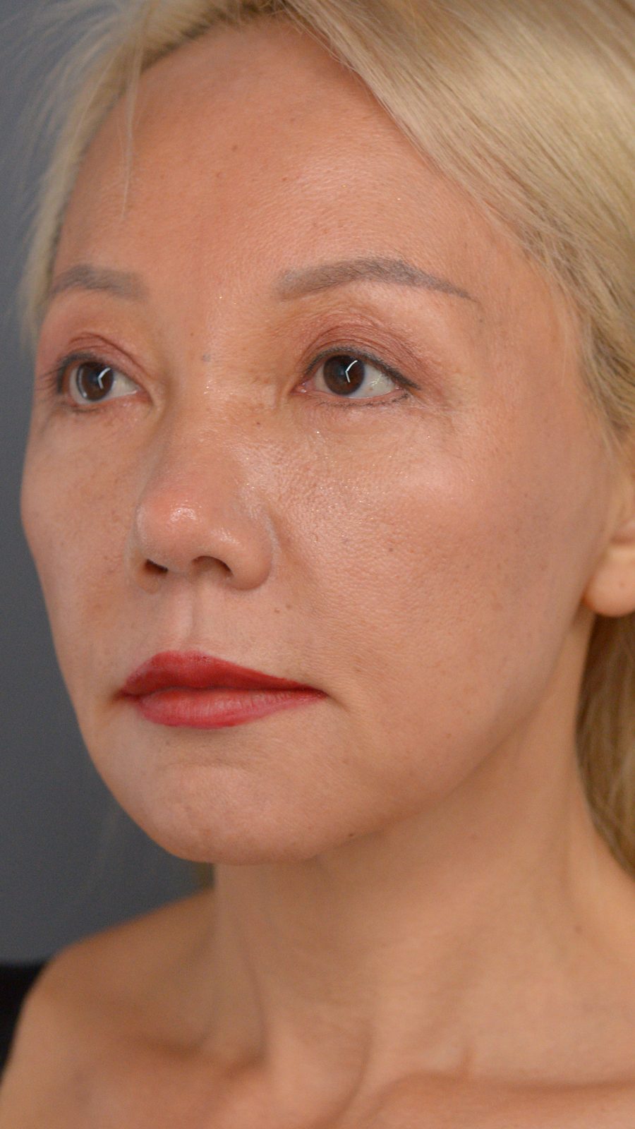 Ponytail Facelift before and after, case 01, view 7 (before)