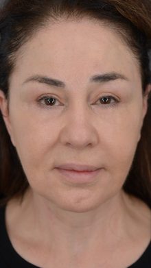 Ponytail Facelift before and after, case 02 (after)