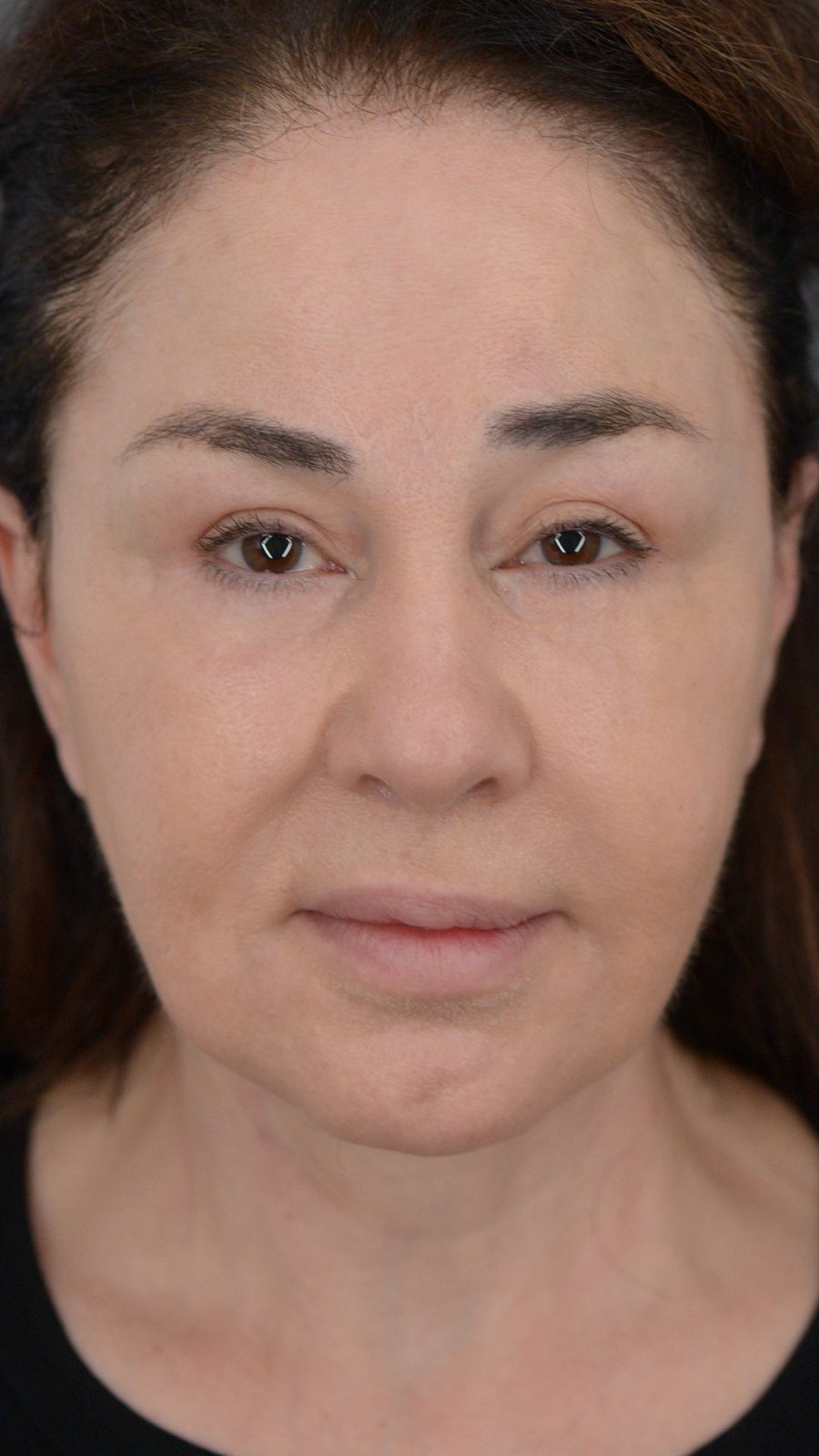 Ponytail Facelift after, case 02