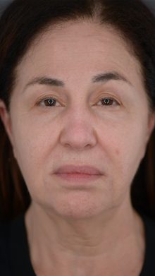 Ponytail Facelift before and after, case 02 (before)