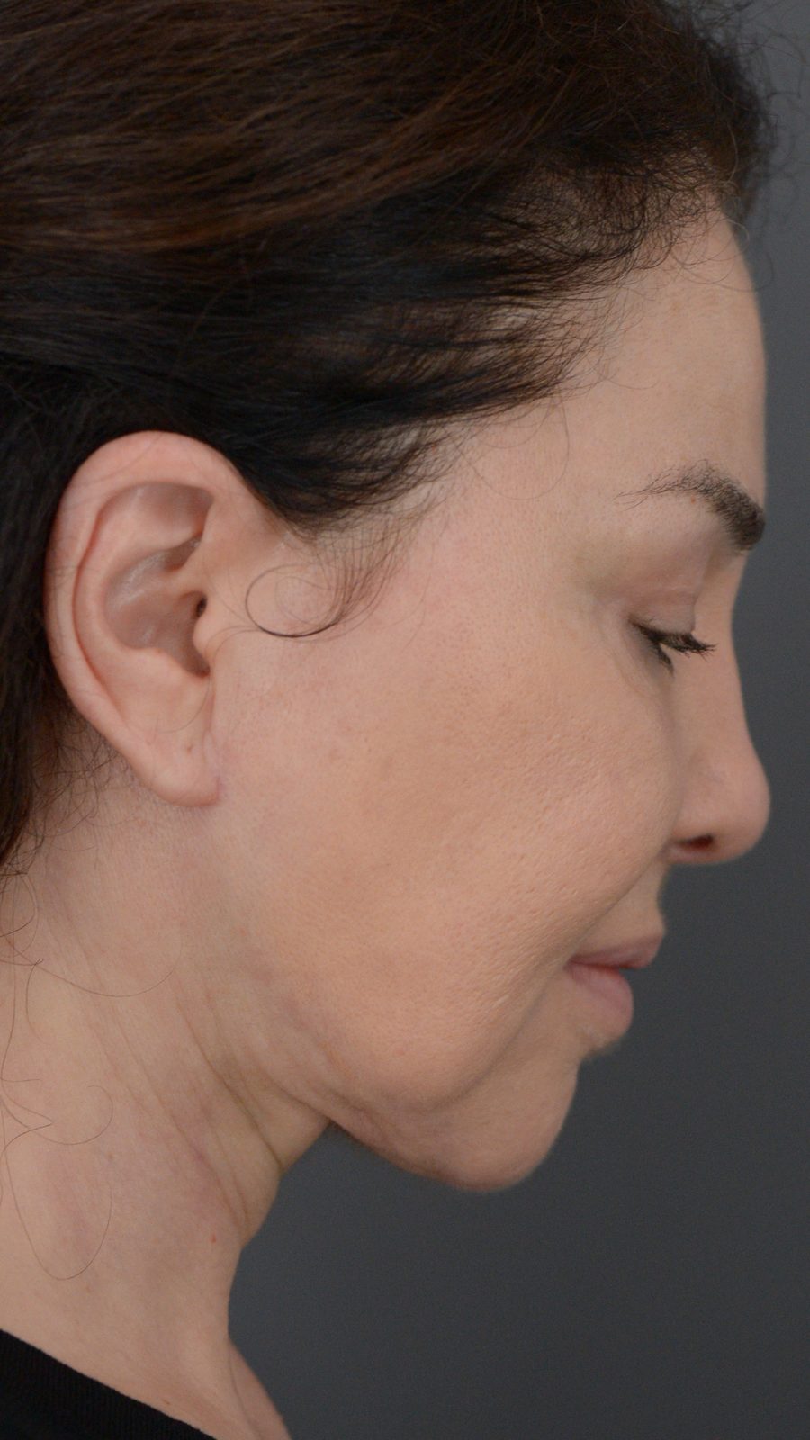 Ponytail Facelift before and after, case 02, view 3 (after)